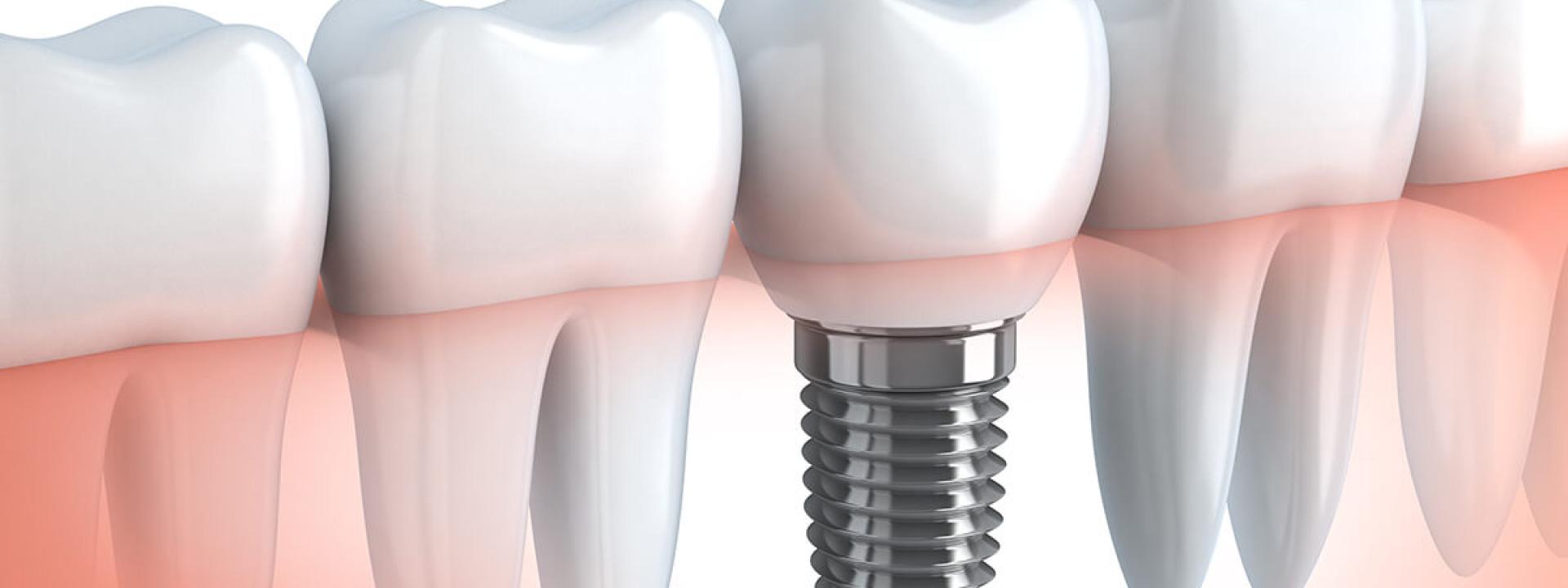 Metal Free Dental Implants in Beverly Hills CA Area
