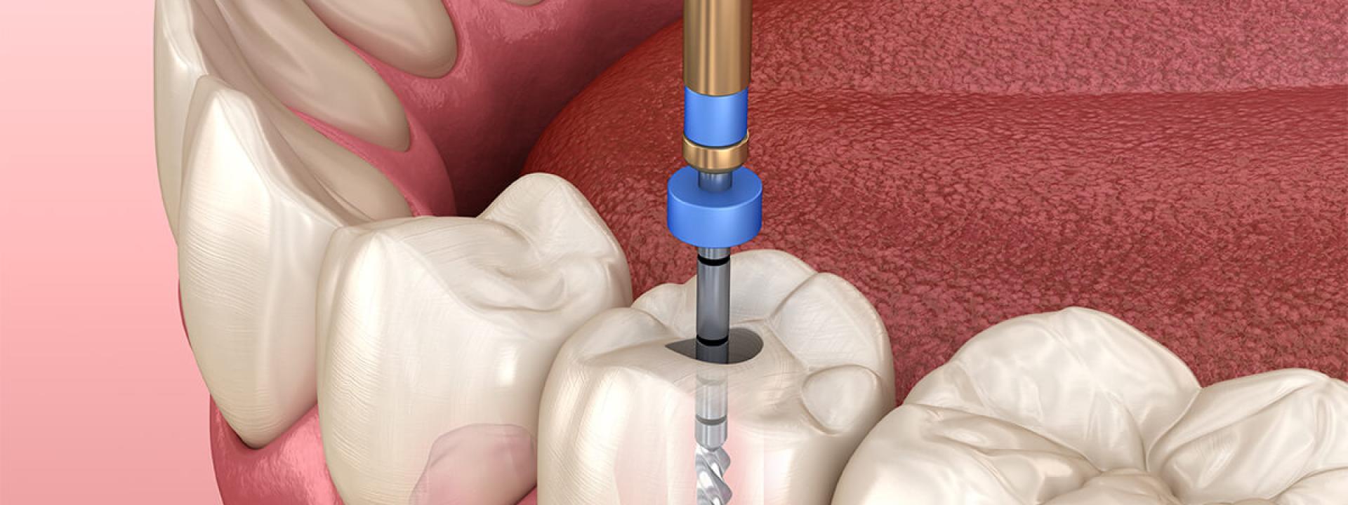 Root Canal Infection Treatment in Beverly Hills CA Area