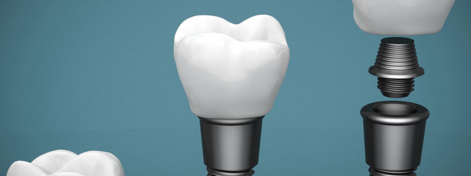 Implants