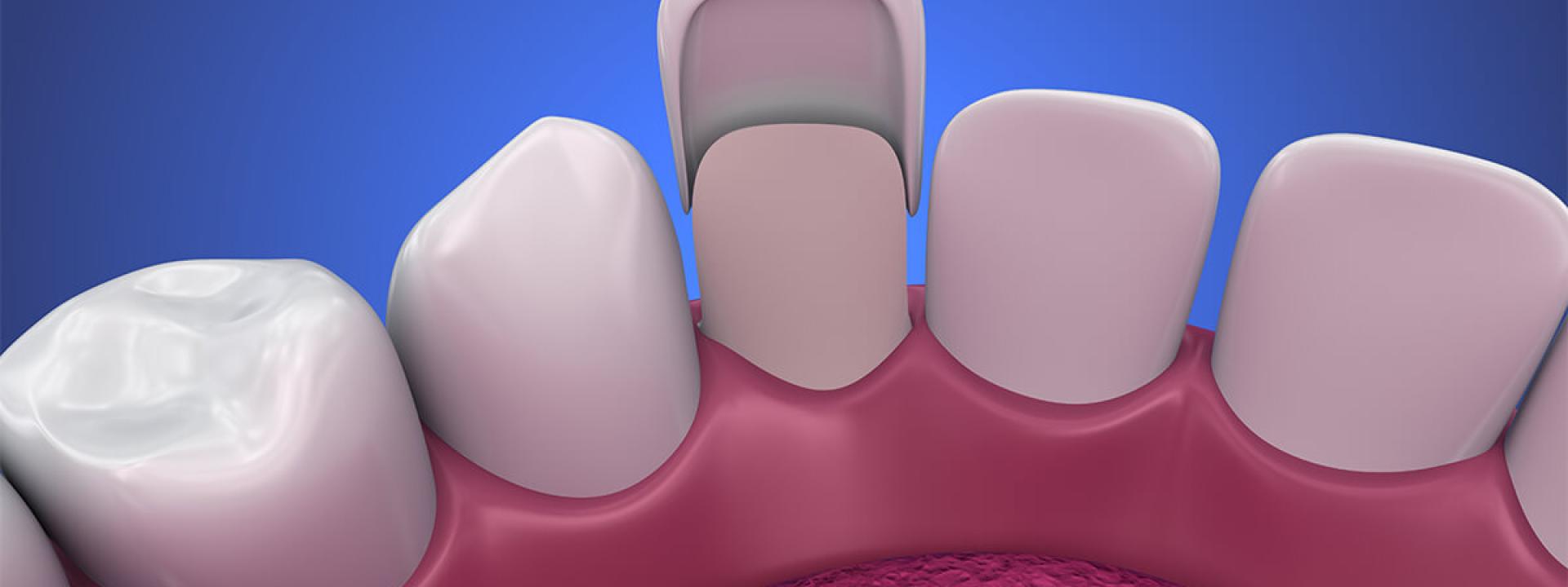 Veneers for Gaps in Teeth Beverly Hills CA Area