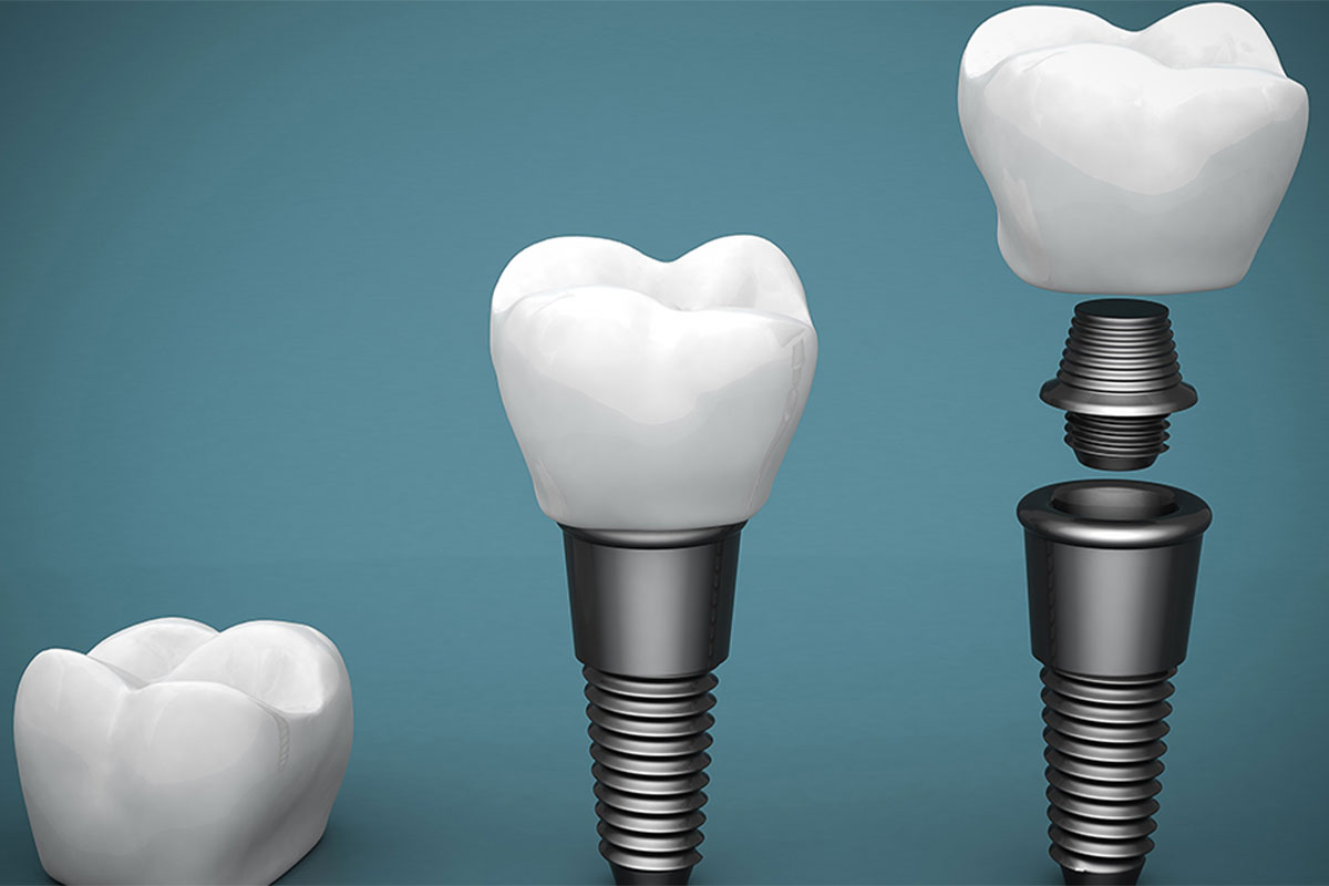 Implants