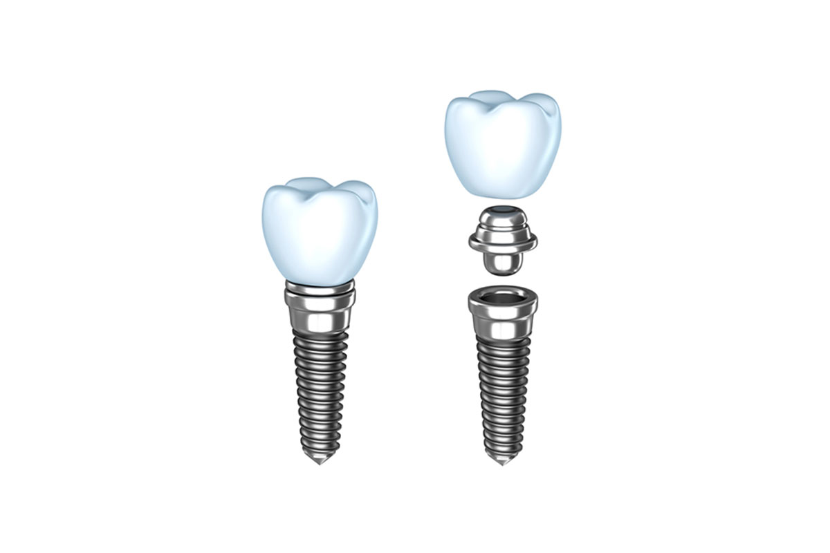 Dental implants