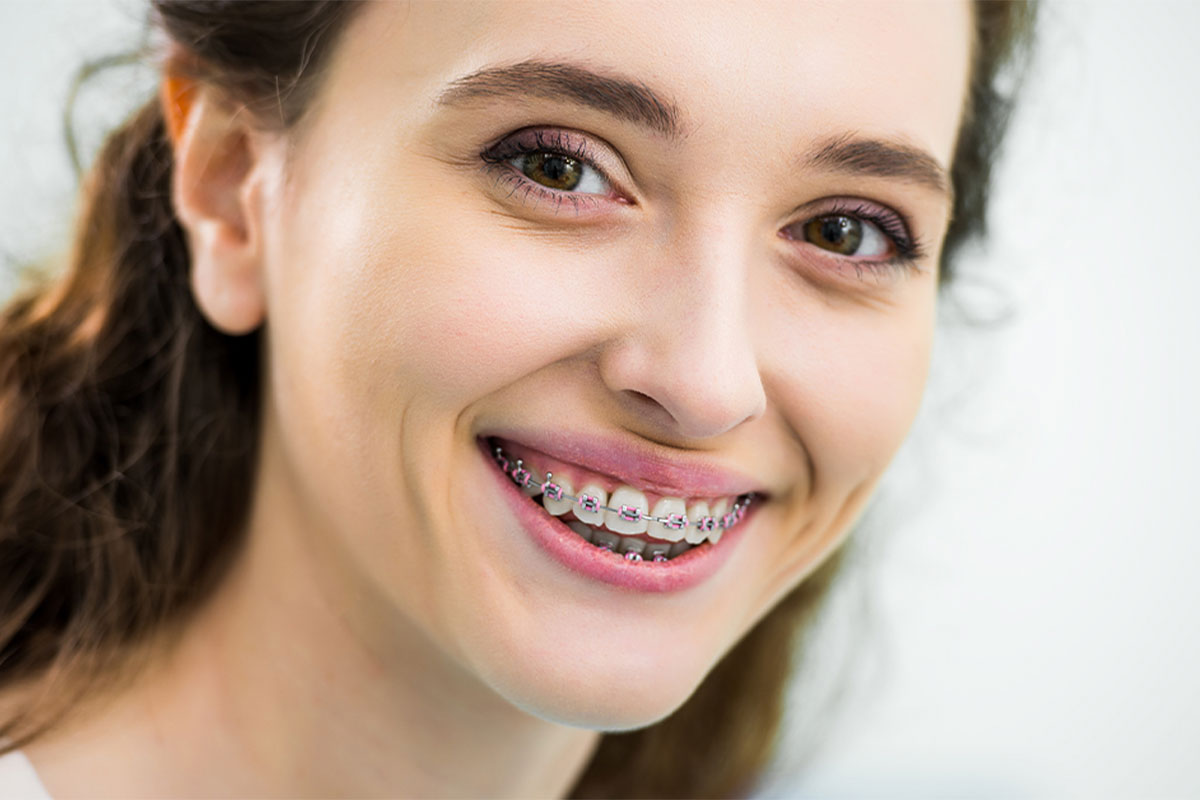 Braces