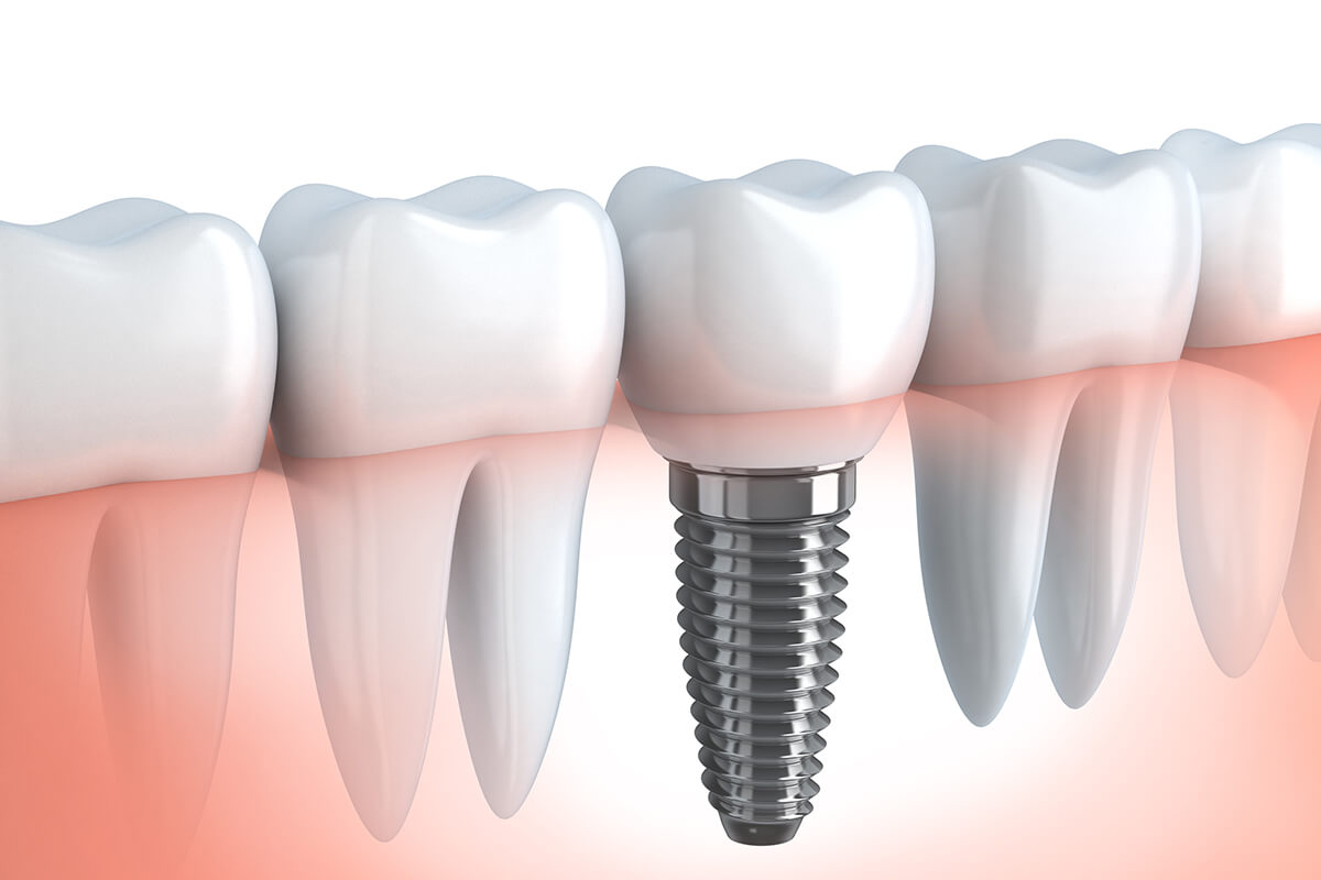 Metal Free Dental Implants in Beverly Hills CA Area