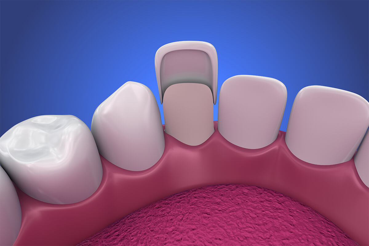 Veneers for Gaps in Teeth Beverly Hills CA Area
