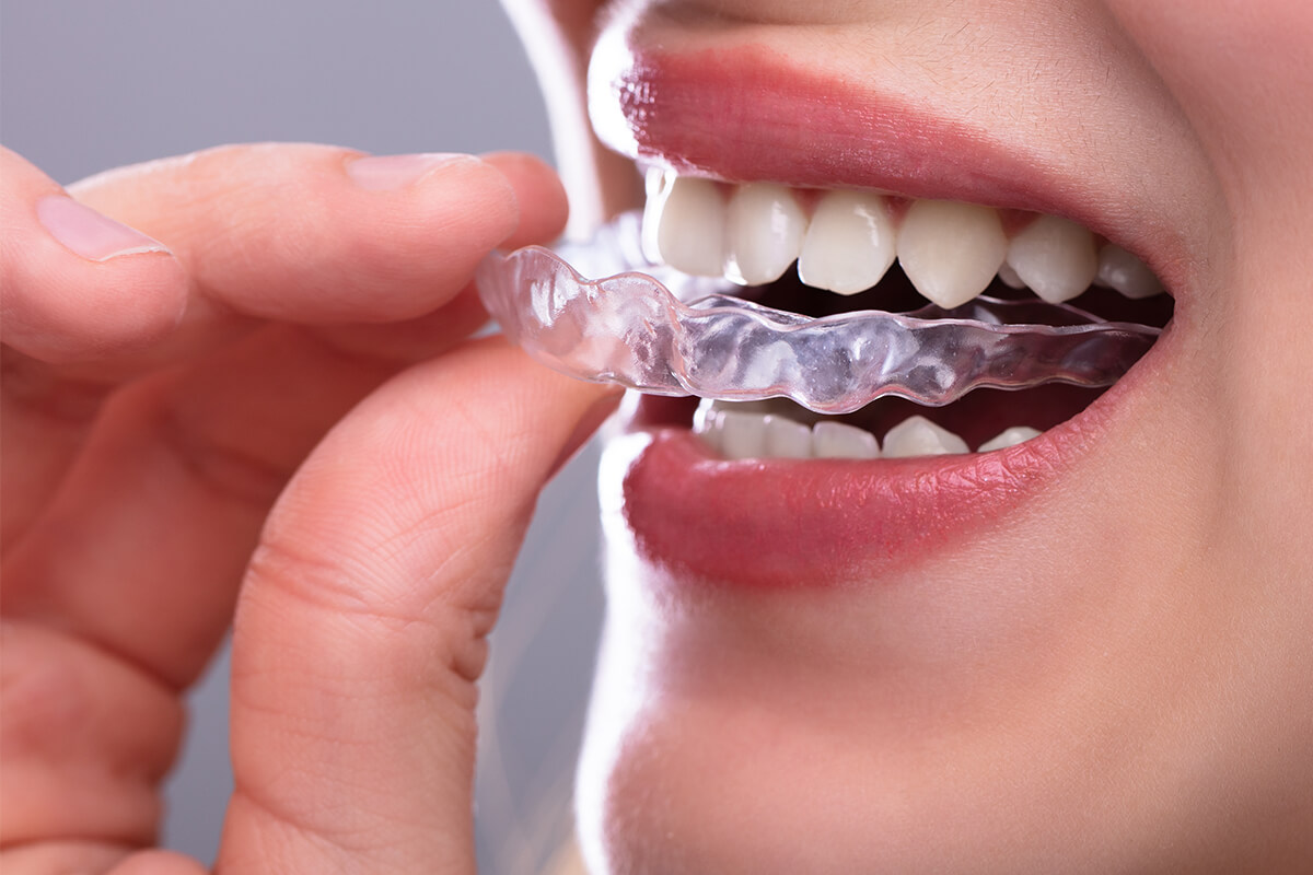 Invisalign Clear Aligners in Beverly Hills CA Area