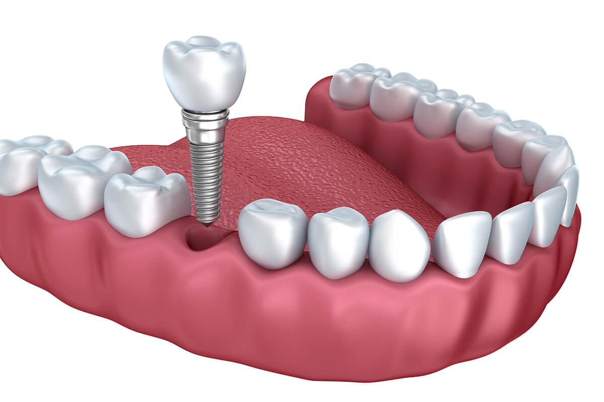 Cosmetic Tooth Replacement in Beverly Hills CA Area